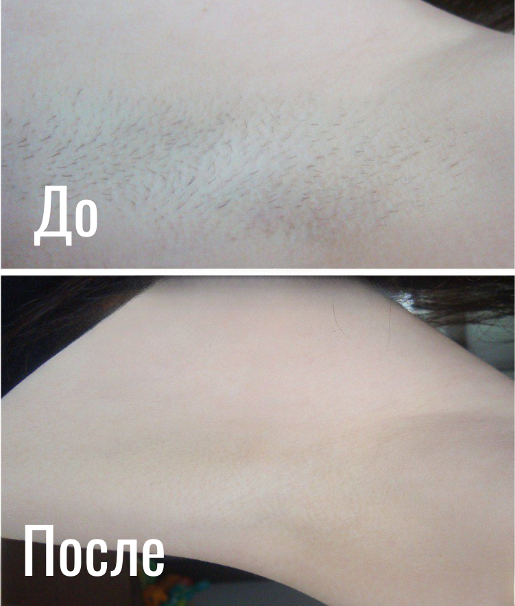 Лазерная эпиляция · подмышки